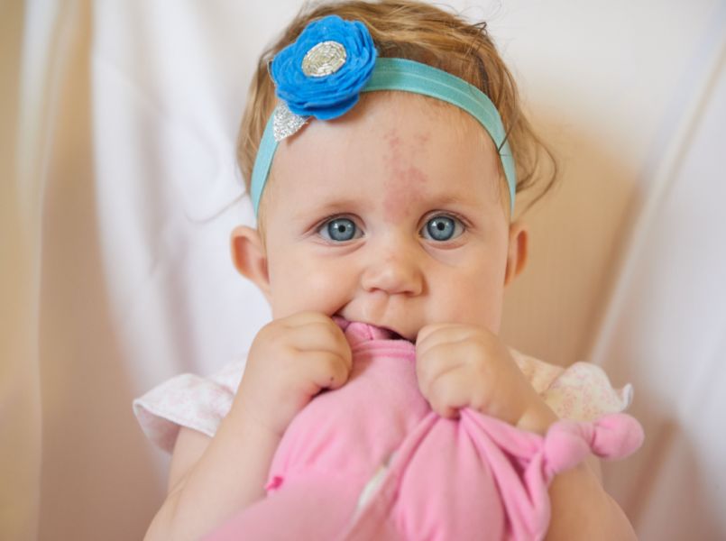 Wijnvlek: is deze roze vlek gevaarlijk voor mijn baby?